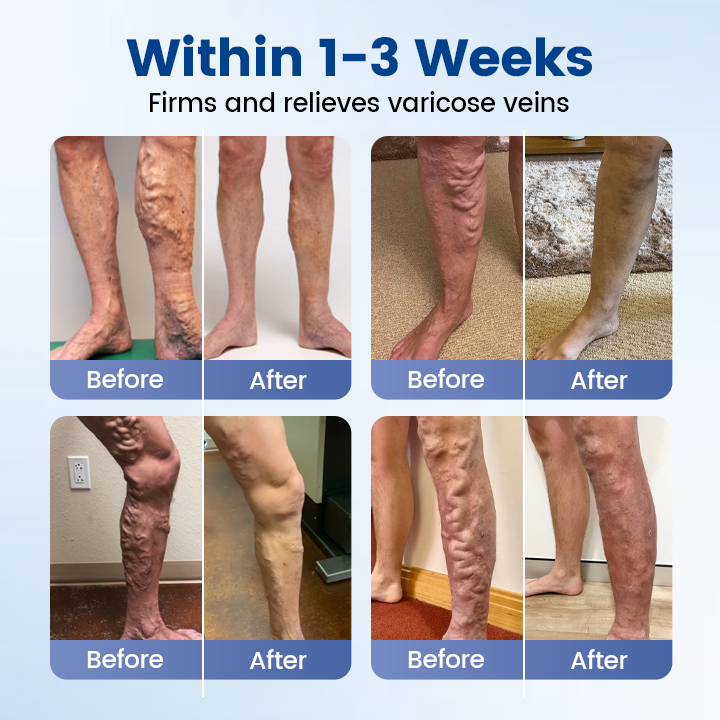 👨‍⚕️🔥Diystar® VeinEase Microneedle Care Patch⚡Instant Relief, Long-Term Results