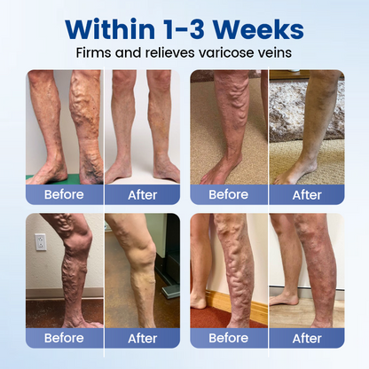 👨‍⚕️🔥Diystar® VeinEase Microneedle Care Patch⚡Instant Relief, Long-Term Results