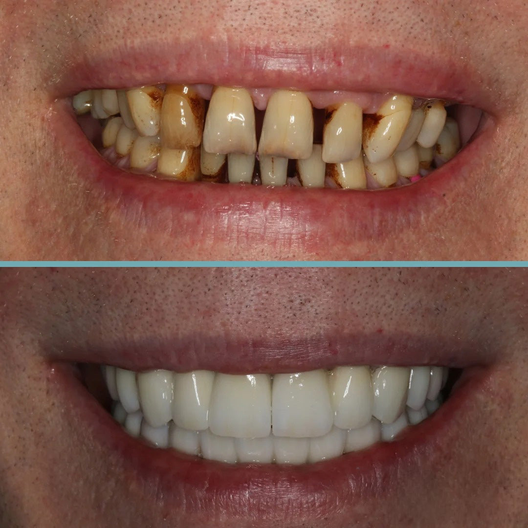 Qooes™ Niacinamide Whitening Toothpaste