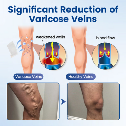 👨‍⚕️🔥Diystar® VeinEase Microneedle Care Patch⚡Instant Relief, Long-Term Results