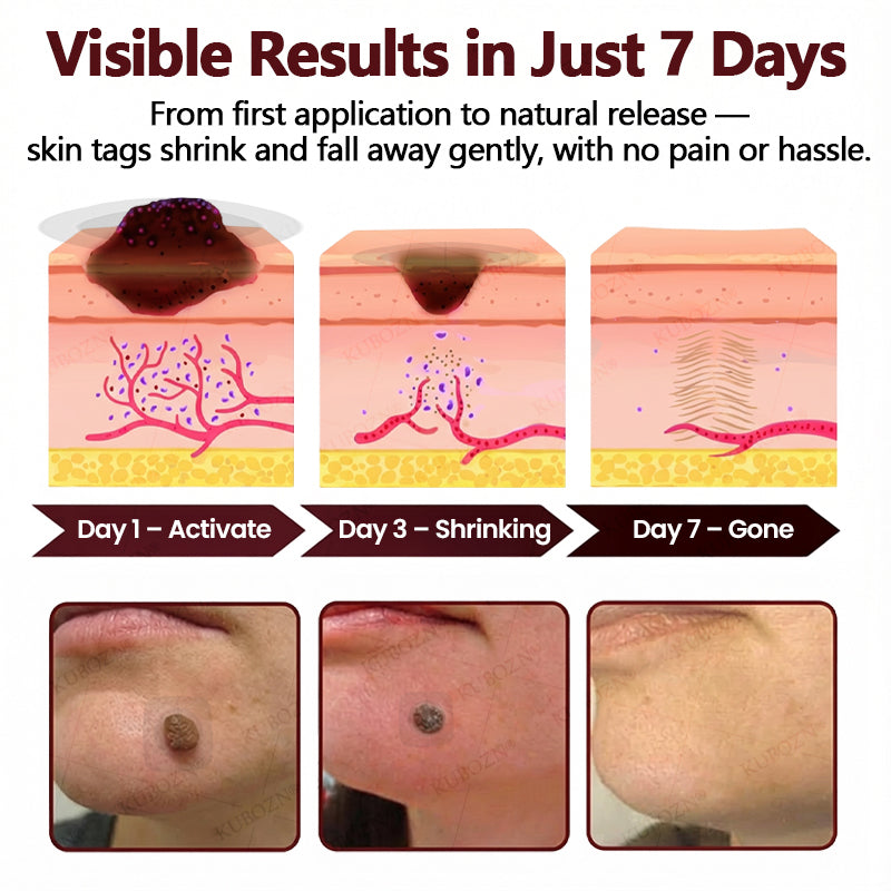 Cheemex® OryzaDarts TAG’GONE Patch✨Pain-Free Root-Level Removal Powered by Black Rice MicroDarts.