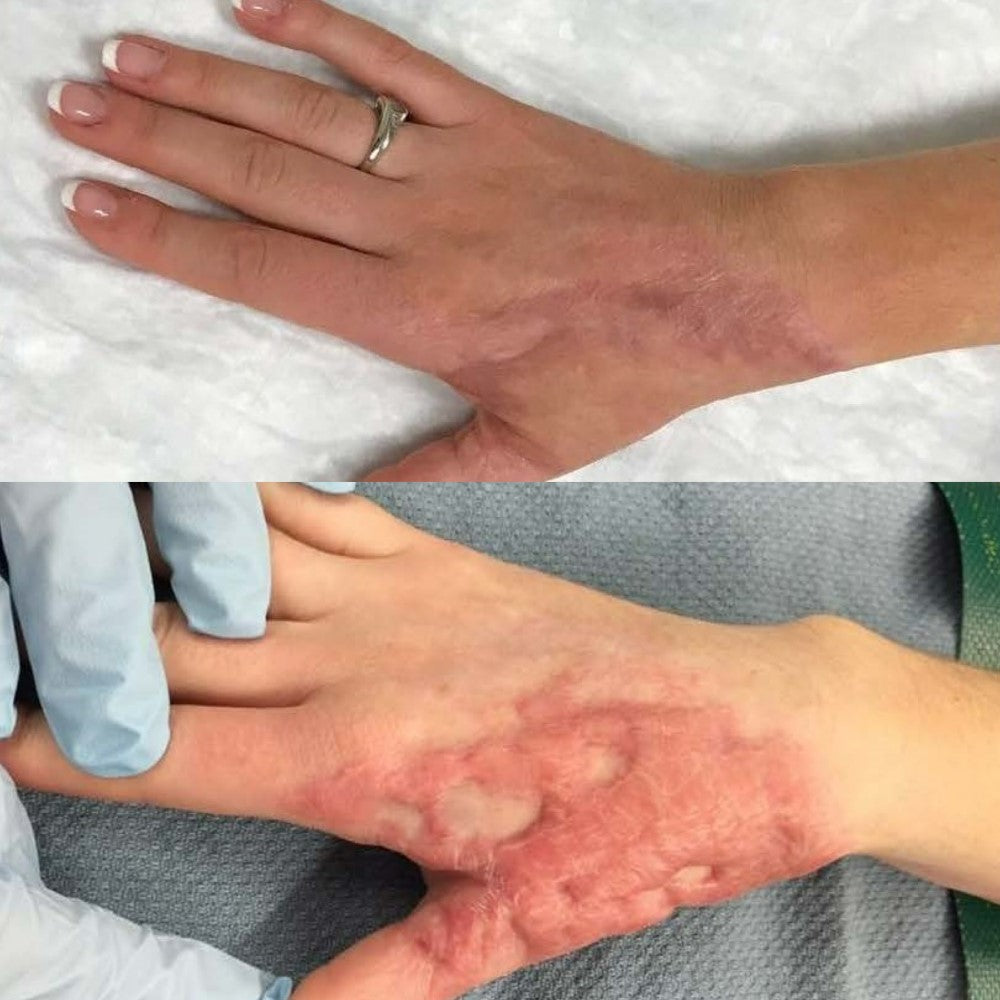 Medazy® ReGenScar Stem Cell Scar Gel